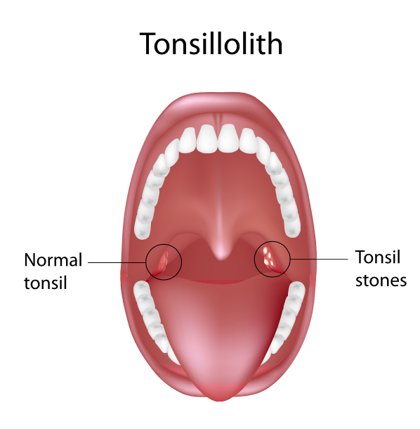 Tonsil Size Chart